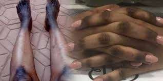 La dépigmentation: un danger pour la santé